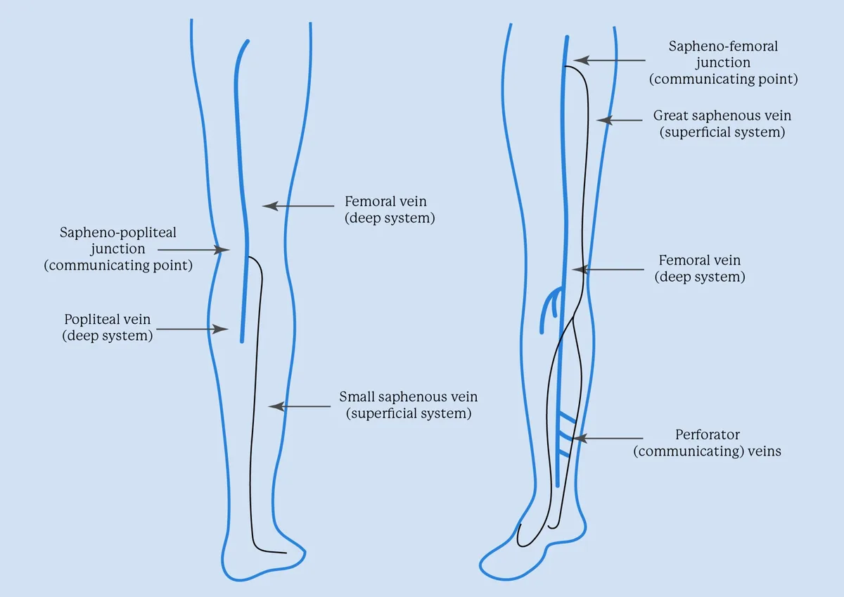Deep Vein Thrombosis (DVT)