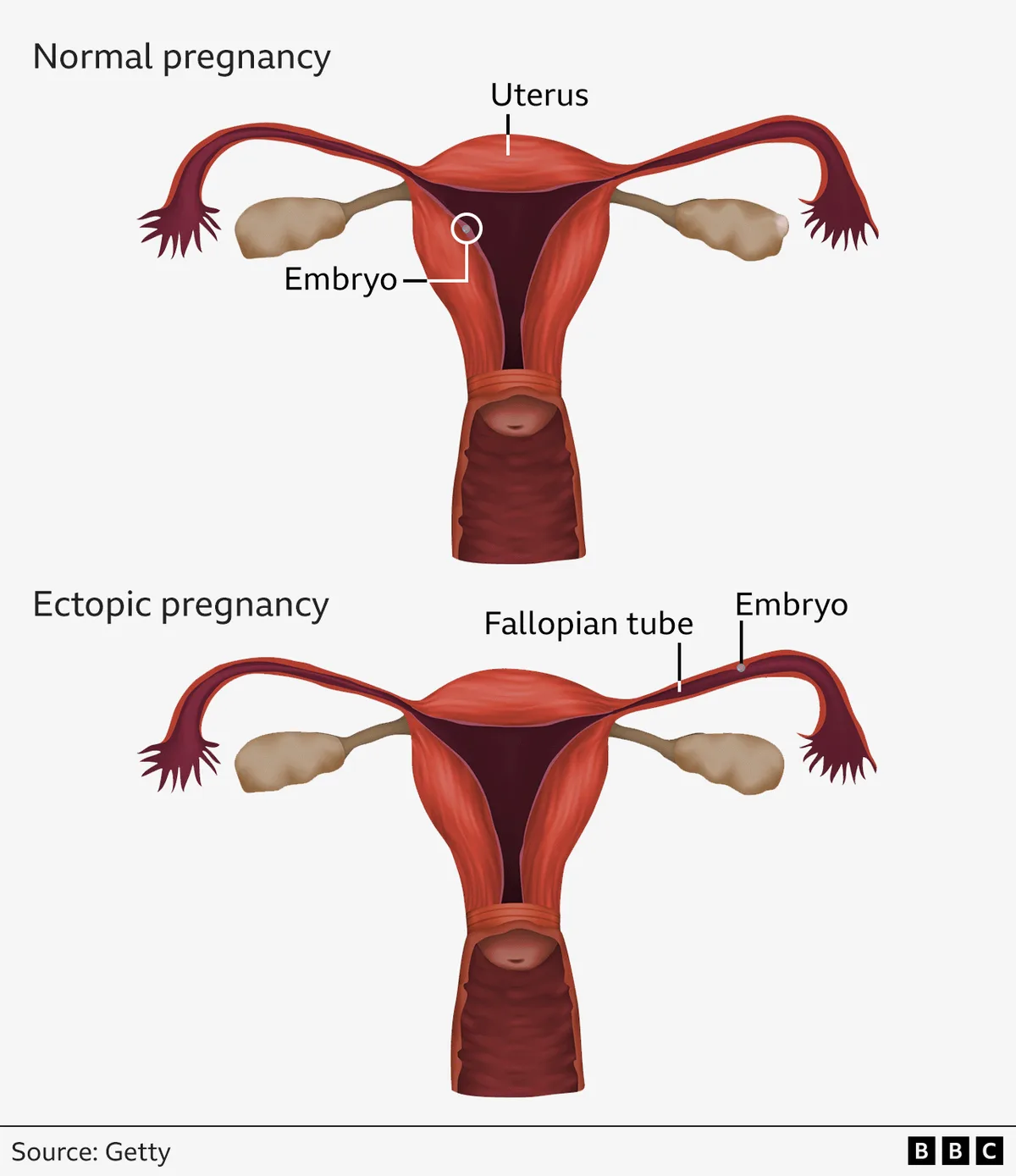 ectopic pregnancy anatomy