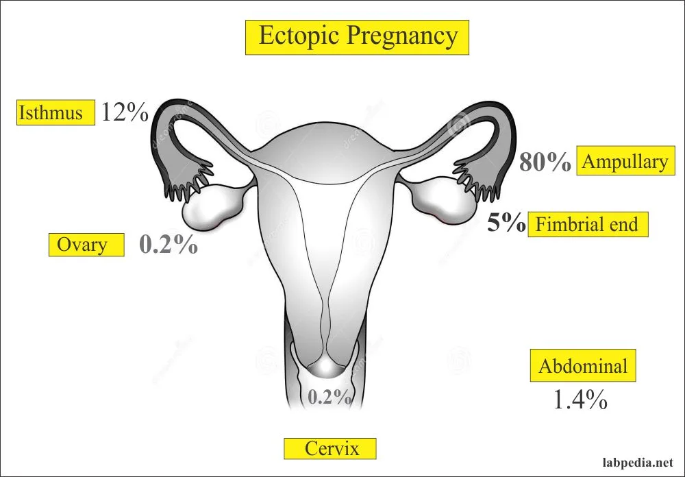 Ectopic Pregnancy