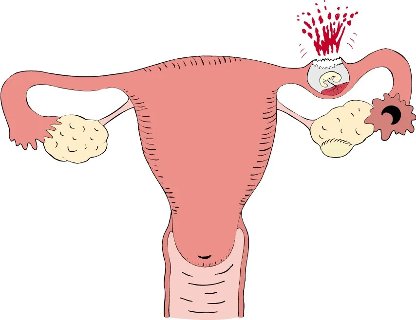 ectopic pregnancy warning signs medical illustration