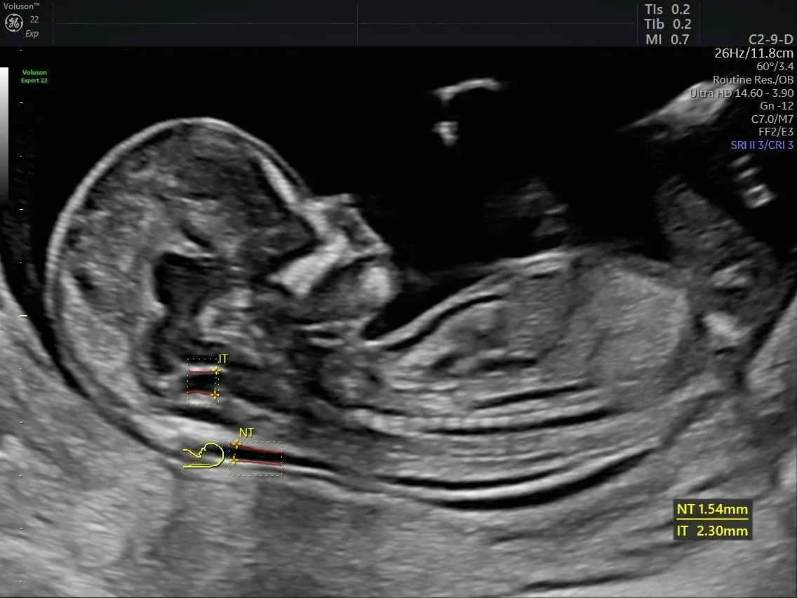First trimester ultrasound scan