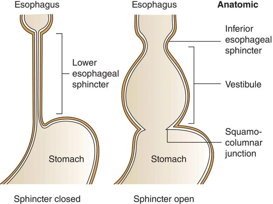 Lower Esophageal Sphincter (LES)