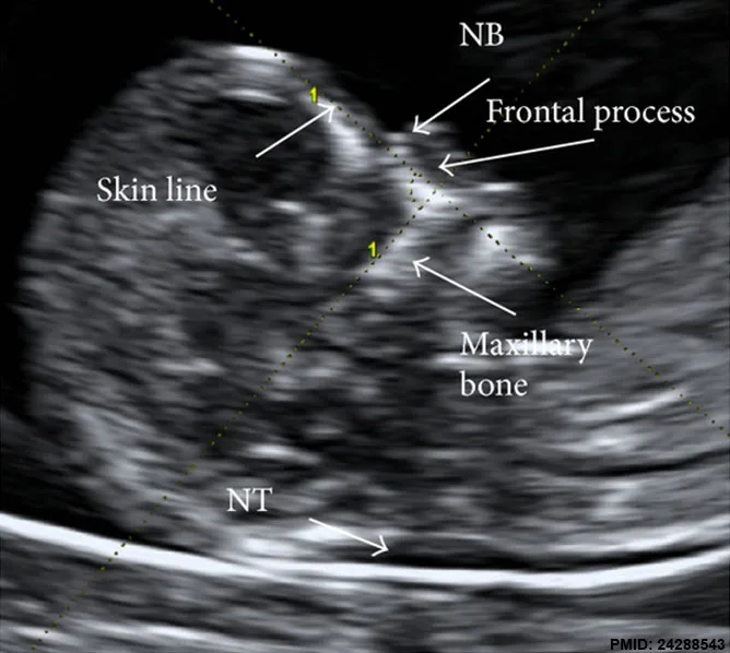 Nuchal Translucency scan