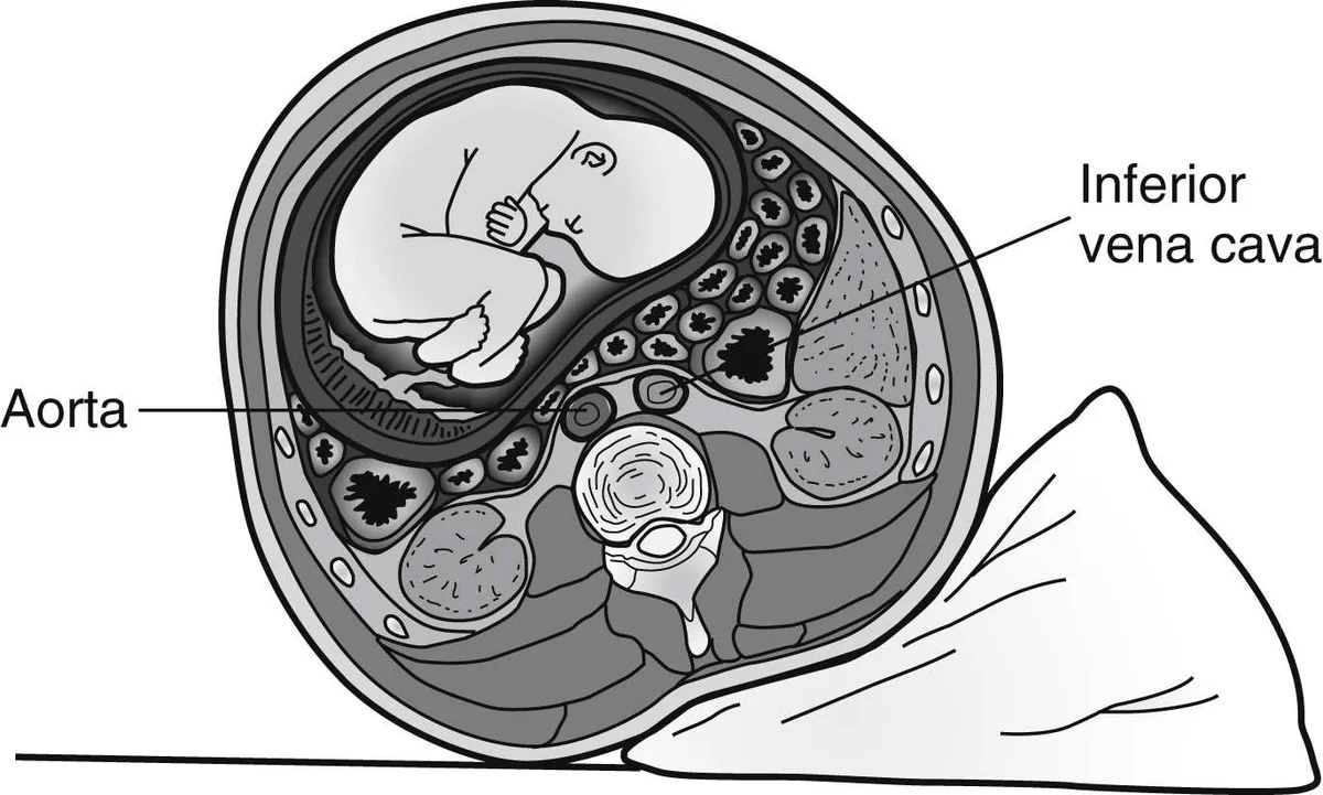 supine hypotensive syndrome