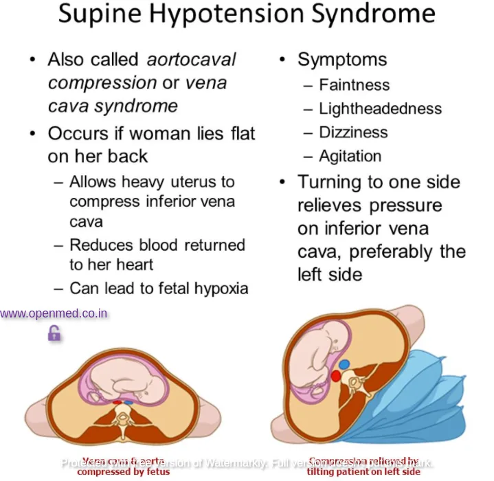 Supine Hypotensive Syndrome (SHS) / Aortocaval Compression